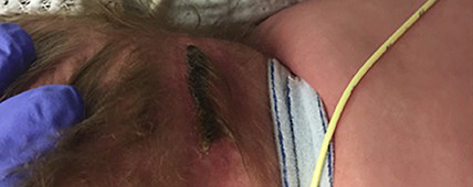 10-month-old patient 1 during low air loss treatment