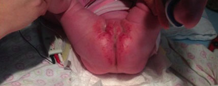 4-month-old patient 2 before low air loss treatment