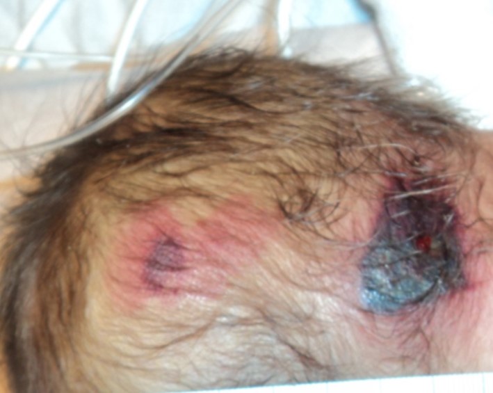 Pressure Ulcers on back of infant's head