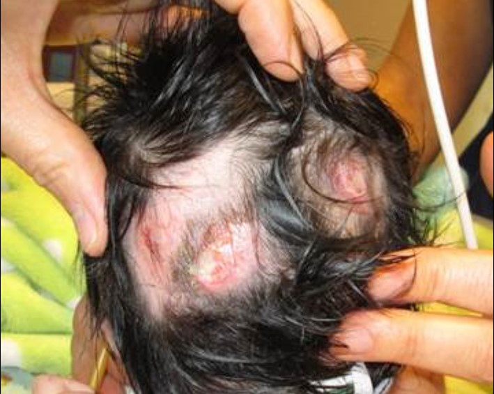 Pressure Ulcers on back of another infant's head