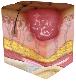 Dark Skin Stage 2 Pressure Injury