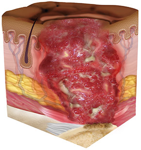 Stage 4 Pressure Ulcer/Injury:​