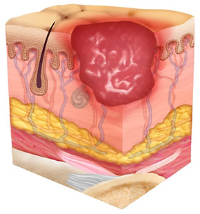 Stage 2 Pressure Ulcer