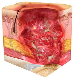 Stage 4 Pressure Ulcer/Injury:​