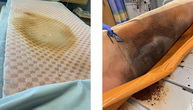 Unprotected foam mattress - interior damage