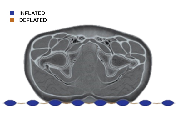 cross section of torso and Patient Care Plus support surface